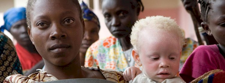 С начала пандемии резко возросла угроза жизни людей с альбинизмом