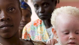 С начала пандемии резко возросла угроза жизни людей с альбинизмом