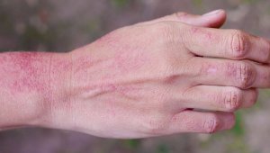 Два основных вида кожных проявлений омикрона выявили ученые
