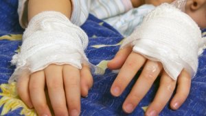 В Шымкенте получивший тяжелые ожоги 10-летний мальчик перенес 19 операций