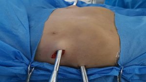 Алматинские врачи провели двум подросткам операцию по исправлению грудной клетки