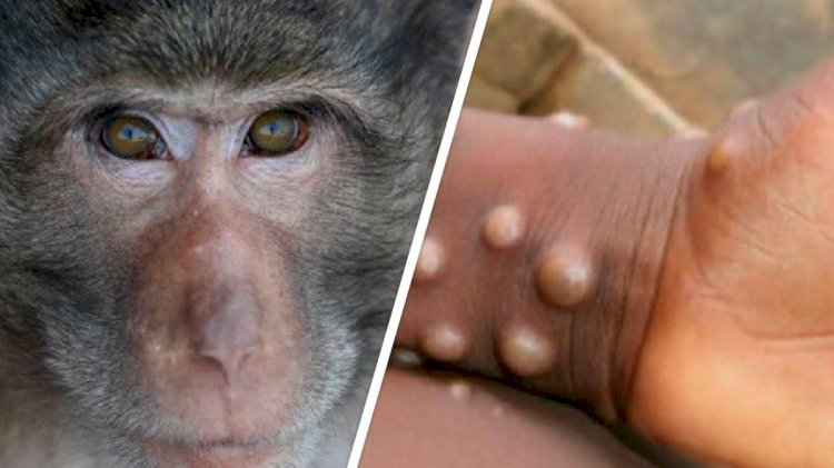В Казахстане приняли профилактические меры по недопущению завоза оспы обезьян