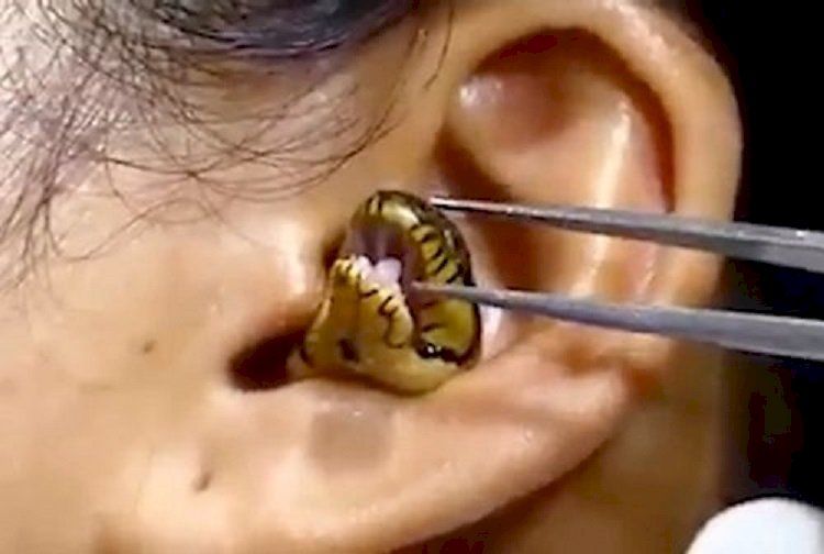 Видео извлечения живой змеи из уха женщины шокировало пользователей сети