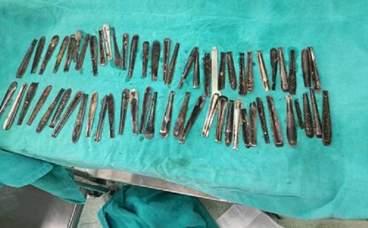 Более 60 ручек от ложек обнаружили врачи в желудке мужчины