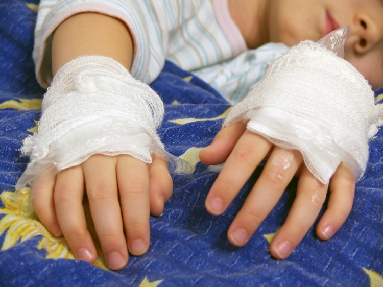 В Шымкенте получивший тяжелые ожоги 10-летний мальчик перенес 19 операций
