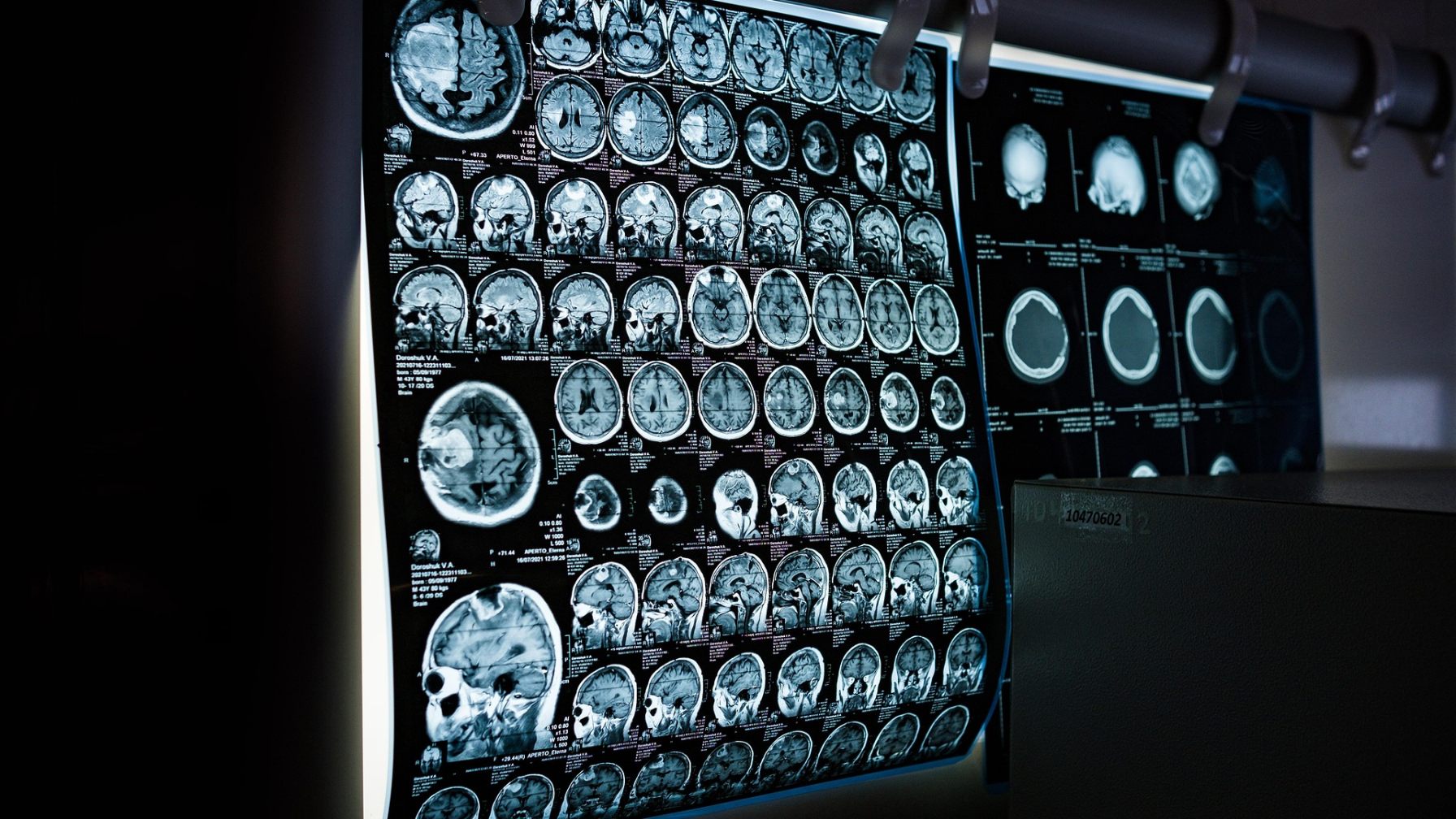 В Казахстане ИИ помогает врачам быстрее выявлять инсульт и онкологические заболевания